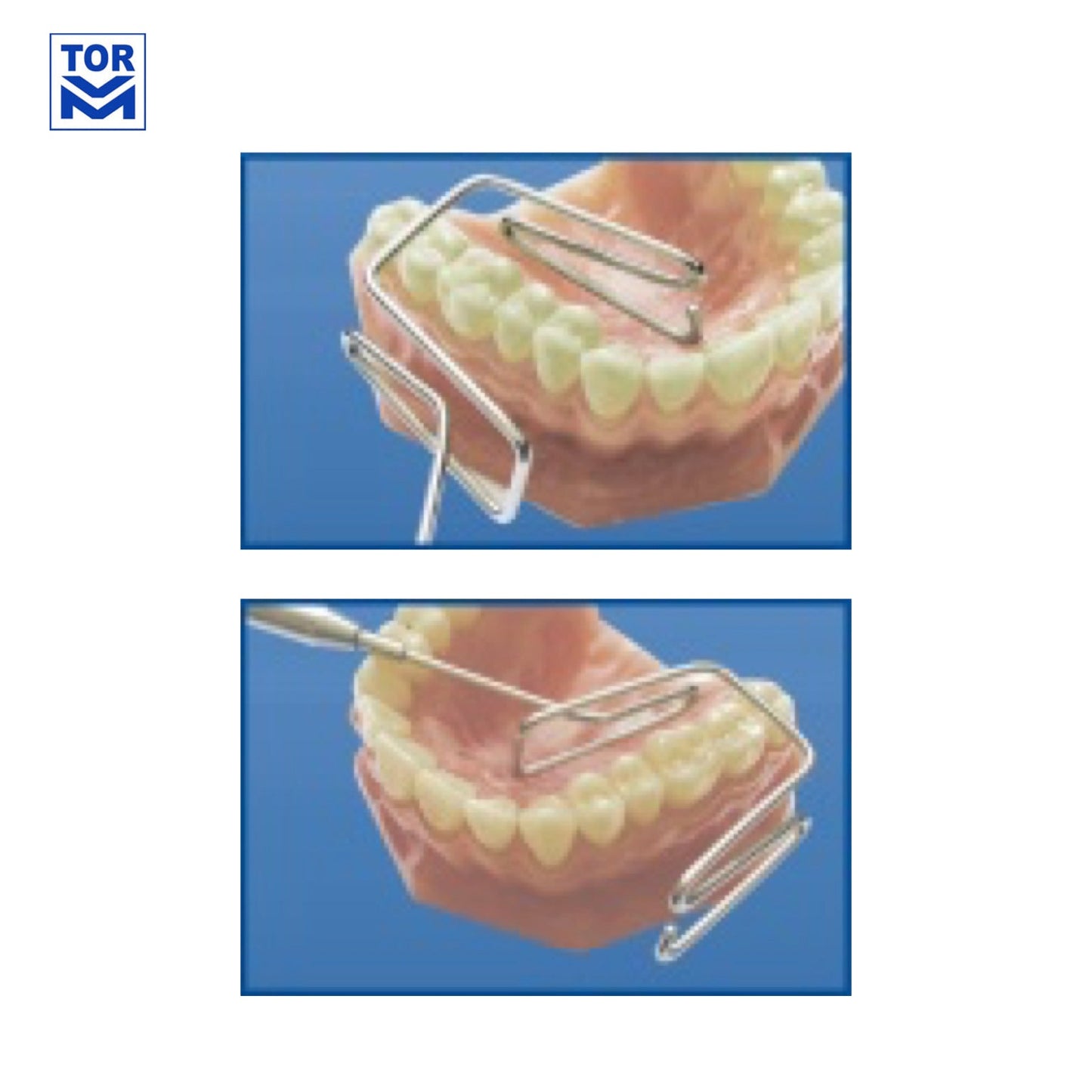 Lingual Retractor with handle - Incidental